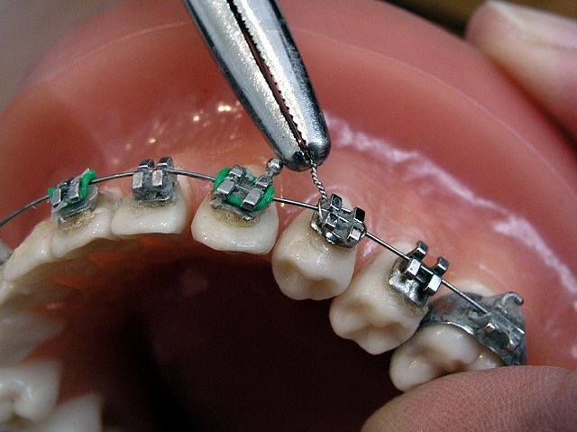 Centro Dental Gil tratamiento de ortodoncia 