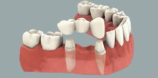 tratamientos dentales 9